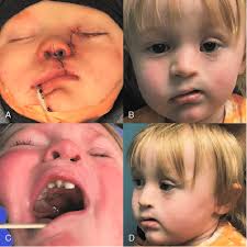 after cleft lip repair