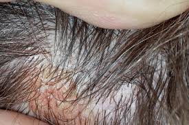 why does my scalp itch 5 common causes