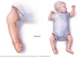 In general, the original correction may be recovered in four to six weeks with manipulations and plaster casts, changed every 14 days, holding the foot in marked abduction and as much dorsiflexion as possible at the ankle in the last cast. Clubfoot Symptoms And Causes Mayo Clinic