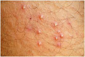 So sexual transmission in the absence of symptoms is far more likely with hsv 2 (genital herpes) than hsv 1. Folliculitis Vs Herpes Symptoms Causes Pictures Differences Health Guide Net