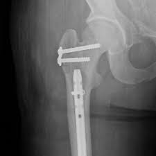 femur fracture fixation shaft