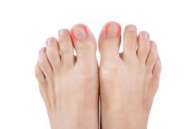 an ingrown toenail