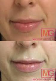 vertical lip lines best fillers how
