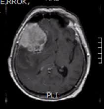 Image result for meningioma brain tumors