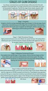 gum disease fallston md gingivitis