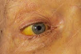 jaundiced eye due to pancreatic cancer