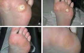 how to treat and prevent plantar warts