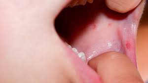 rashes with teething symptoms