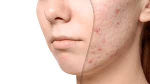 stubborn acne scars