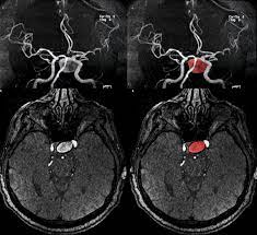 Un aneurisma cerebral es una zona debilitada y abultada en la pared de una arteria cerebral una tac puede ayudar a ver el aneurisma, pero sobre todo muestra la sangre de la hemorragia. Que Pruebas Imagenologicas Utilizar Para Detectar Aneurismas Cerebrales