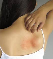 skin allergy symptoms and home remes