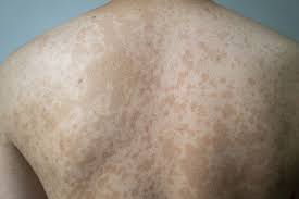 tinea versicolor treatments