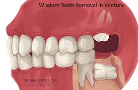ventura wisdom teeth removal cost