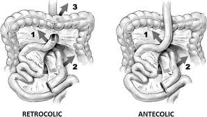 small bowel obstruction after gastric