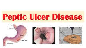 peptic ulcer disease gastric vs