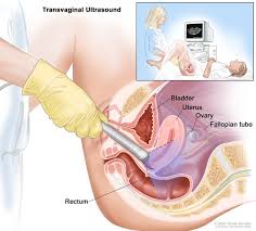 Endovaginal and transperineal scanning as well as graded compression technique now supplement. Definition Of Transvaginal Ultrasound Nci Dictionary Of Cancer Terms National Cancer Institute