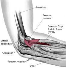 tennis elbow lateral epicondylitis