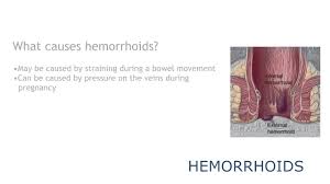 Hemorrhoids Symptoms And Conditions Musc Ddc