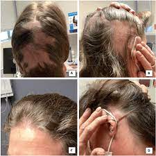 cureus alopecia areata after
