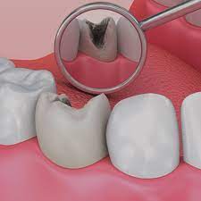 hole in a tooth treatment family