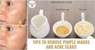 remove acne scars and pimple marks