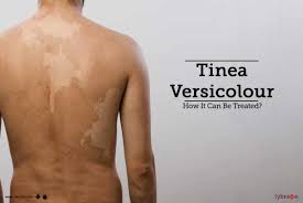 tinea versicolour how it can be
