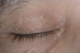 white p on eyelid causes and