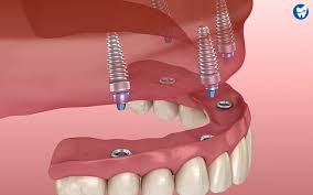 all on 4 dental implants cost