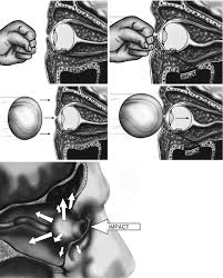 orbital floor fractures springerlink