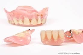 Dentures are full or partial dental prosthesis to replace your missing teeth. Neue Cover Denture Prothese Mit 12 Ersetzten Zahnen Abrechnung