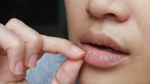 why chapped lips could be a sign of