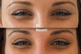 Most cats have beautiful eyes. Fillers Vs Thread Lift Which Is Better For Facial Rejuvenation Costhetics