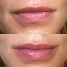 lip injections white rock lip fillers