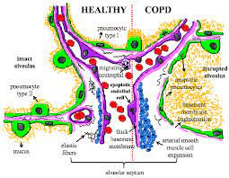 Copd Alveolar Septum In The Copd