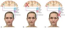 Image result for icd 10 code for right sided facial droop