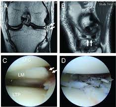 surgical treatment of complex meniscus