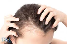 treatments for female hair loss