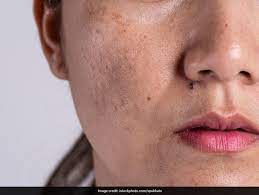 skin pigmentation easy home remes