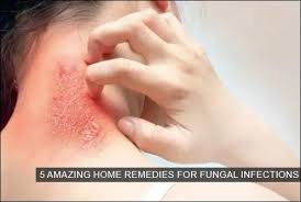 5 amazing home remes for fungal