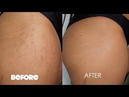 cover your stretch marks for summer