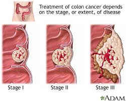 When colon cancer tumors bleed, that causes iron loss in your body. Colon Cancer Multimedia Encyclopedia Health Information St Luke S Hospital