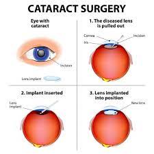 what are the symptoms of cataracts
