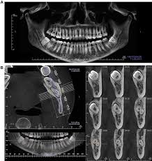 mandibular third molar surgery