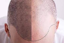 scalp micropigmentation brow design