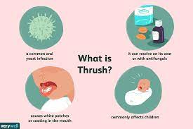 hiv and thrush candidiasis