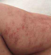 8 types of rashes that can be a sign of