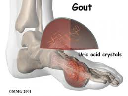 Image result for gout punca