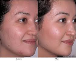anti aging skin treatment
