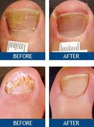 toenail fungus laser treatment by