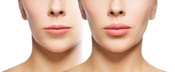 fuller lips without needles lasers